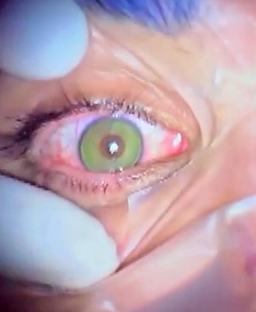 Göz Rengini Değiştirmek Artık Mümkün!